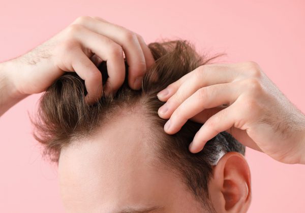 הפתרון האולטימטיבי להתקרחות: הכול על השתלת שיער